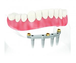 Implant dentaire Bans