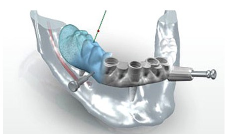 Implant dentaire Bans