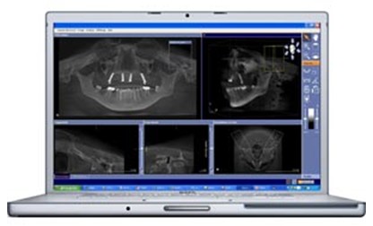 Implant dentaire Bans